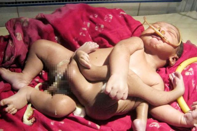 Bayi Lahir dengan 4 Tangan dan Kaki, Apakah Benar Dia Titisan Dewa