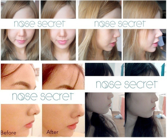 Nose Secret, Teknologi Untuk Hidung Mancung Idaman 1 ROCKETNEWS