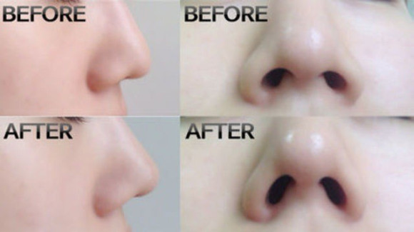 Nose Secret, Teknologi Untuk Hidung Mancung Idaman 3 ROCKETNEWS