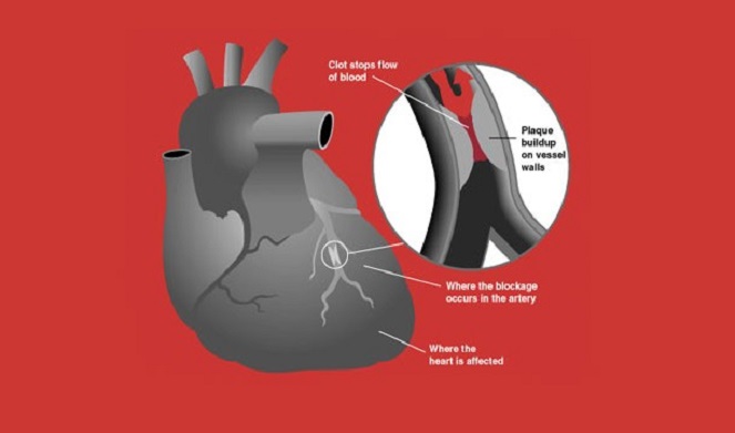 Perokok lebih mudah terkena penyakit jantung [Image Source]