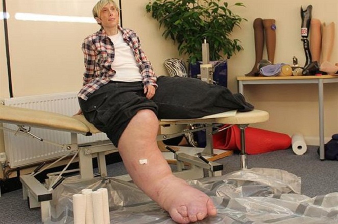 Mandy Sellars, wanita dengan kaki terbesar di dunia [Image Source]