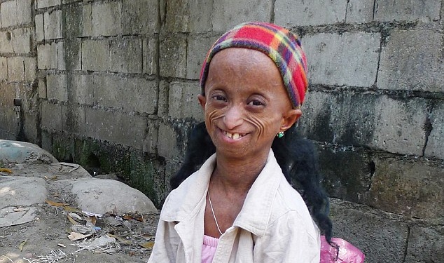 Apa itu Progeria Syndrom