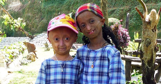 Rela Dijadikan Percobaan Obat Penyembuh Progeria