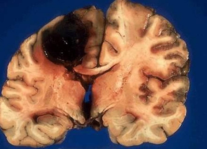 Bagian hitam yang memperlihatkan otak mengalami pendarahan