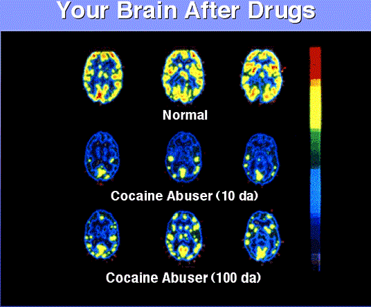 Kokain dapat menghancurkan otak