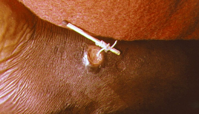 Penyakit Guinea Worm [Image Source]