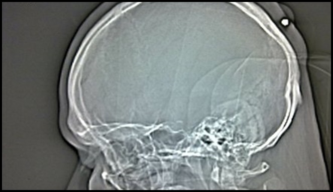Peluru menyasar di kepala [Image Source]