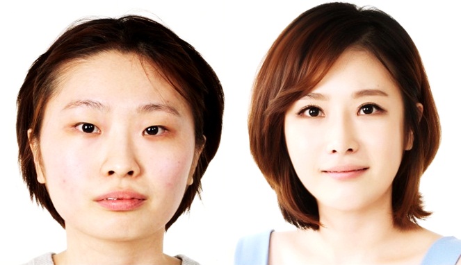Wanita Korea Selatan setelah operasi [Image Source]