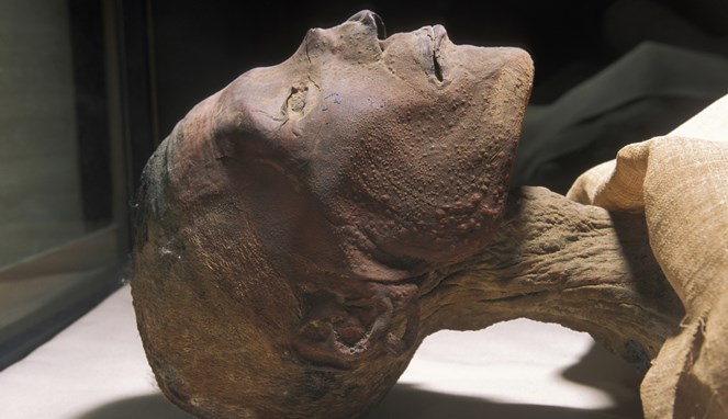 Ramses V dengan Smallpox [Image Source]