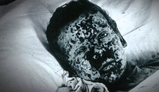 Smallpox meninggalkan bekas luka mengerikan [Image Source]