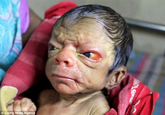 Bayi Bangladesh, lahir dengan kondisi langka, Progeria [image source]